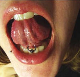 Zungenband-Piercing (Zungenbändchen)